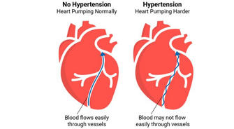 Empowering Your Health: Strategies for Effective Hypertension Management