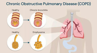 Understanding Chronic Obstructive Pulmonary Disease (COPD): Challenges and Opportunities in Management